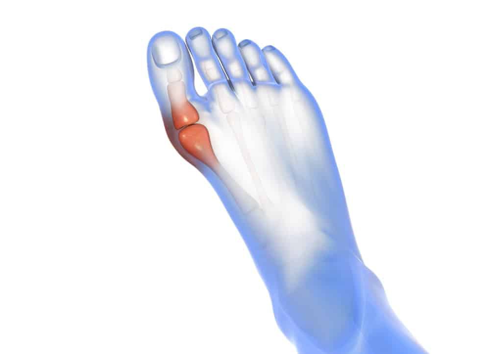 Hallux valgus